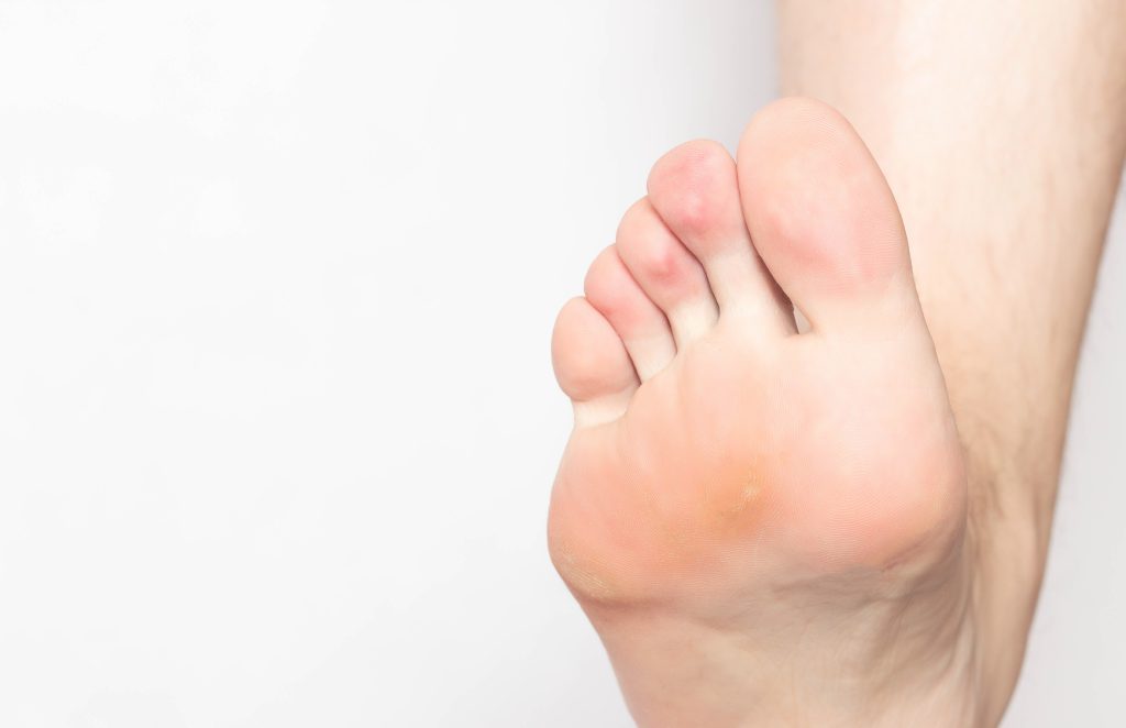 Problem skin with calluses and corns on the sole of the human foot, dry and rough skin, inflammation and pain, foot, close-up, copy space, dermatology